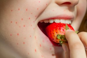 face with rashes after eating strawberry food allergy